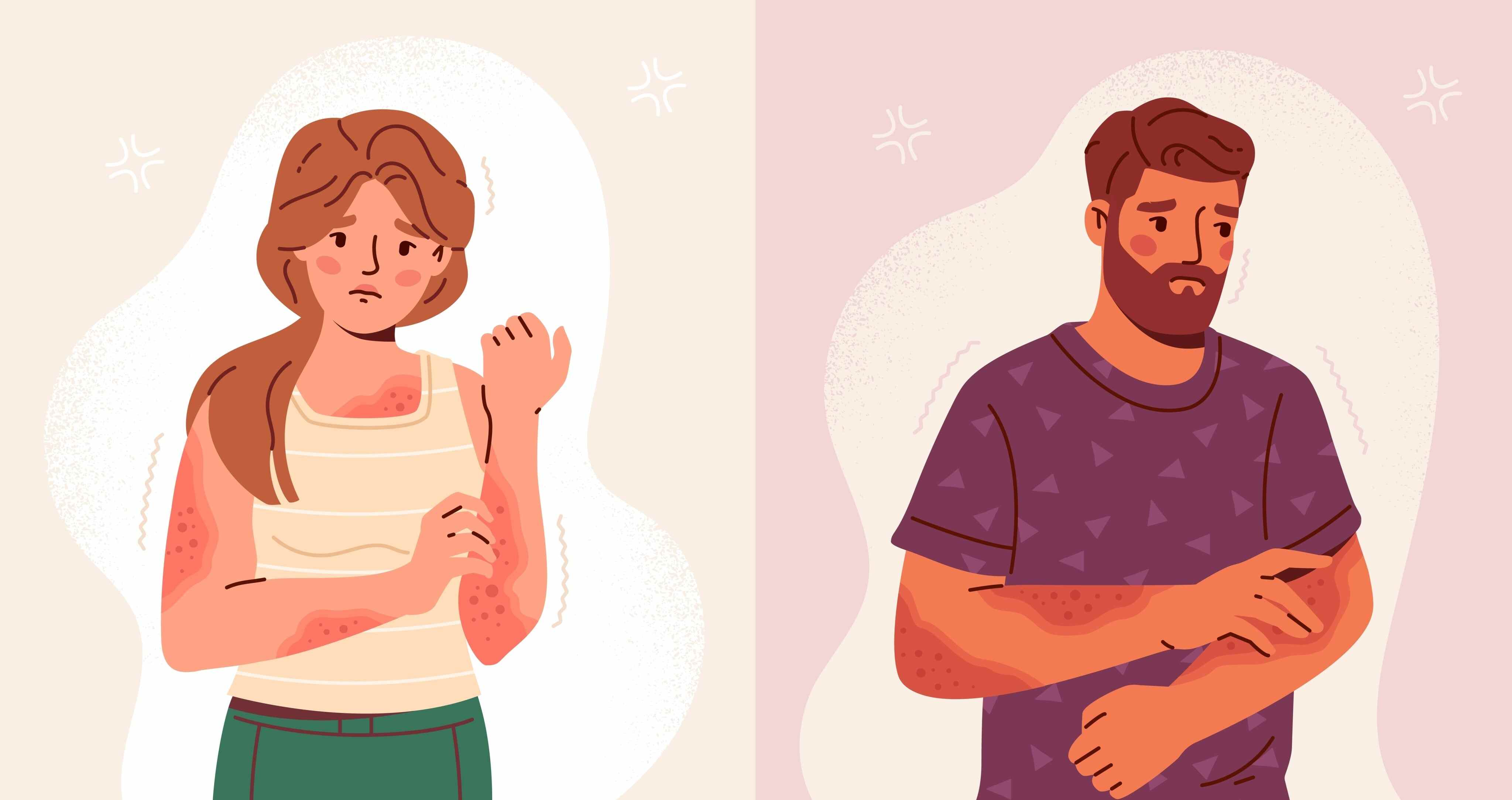 Dermatologist explains all about heat rash and how you can ditch the ...