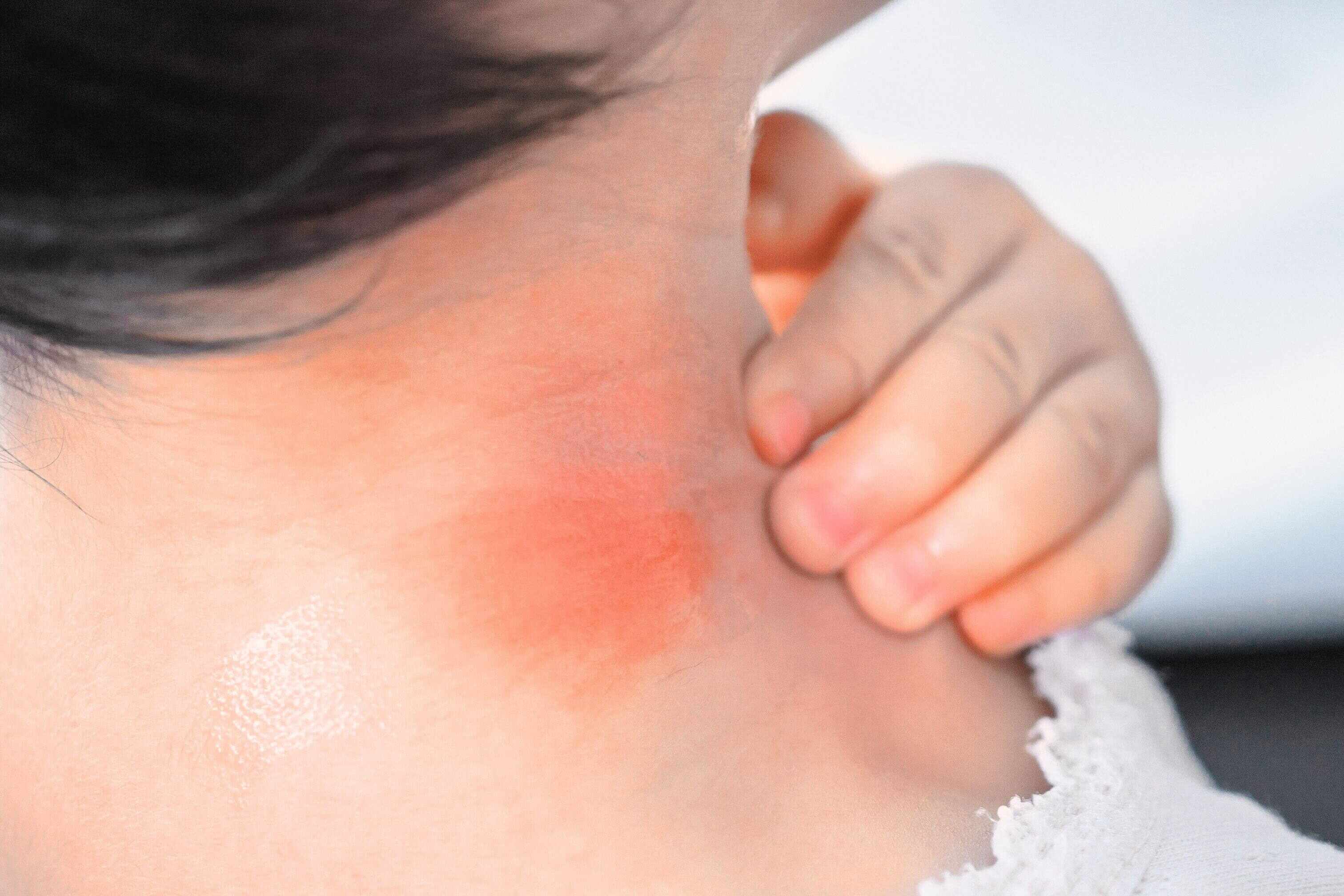 Research revealed that scratching bug bites worsens inflammation, triggers mast cells and prolongs itching. Photo: Shutterstock 