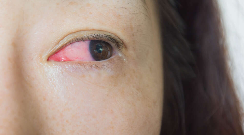 Zika can live in eyes, tears