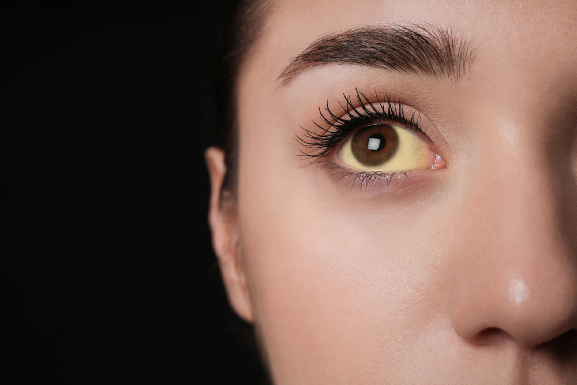 A common symptom of hepatitis is jaundice, a liver-related condition that causes a yellowing of the skin and the whites of the eyes. Photo: Shutterstock