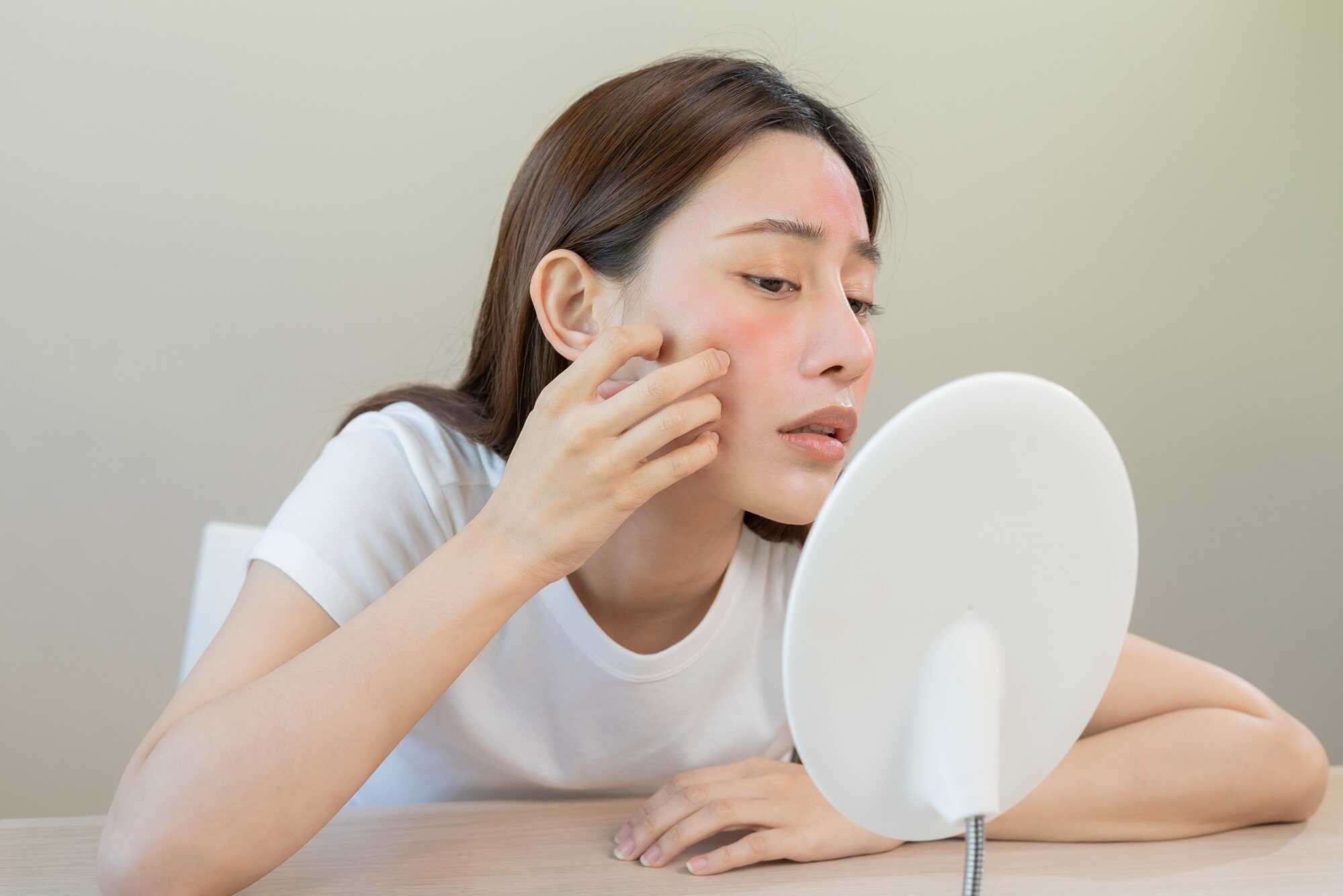 According to Chinese medicine, acne, eczema and other skin conditions can be affected by what you eat. Photo: Shutterstock