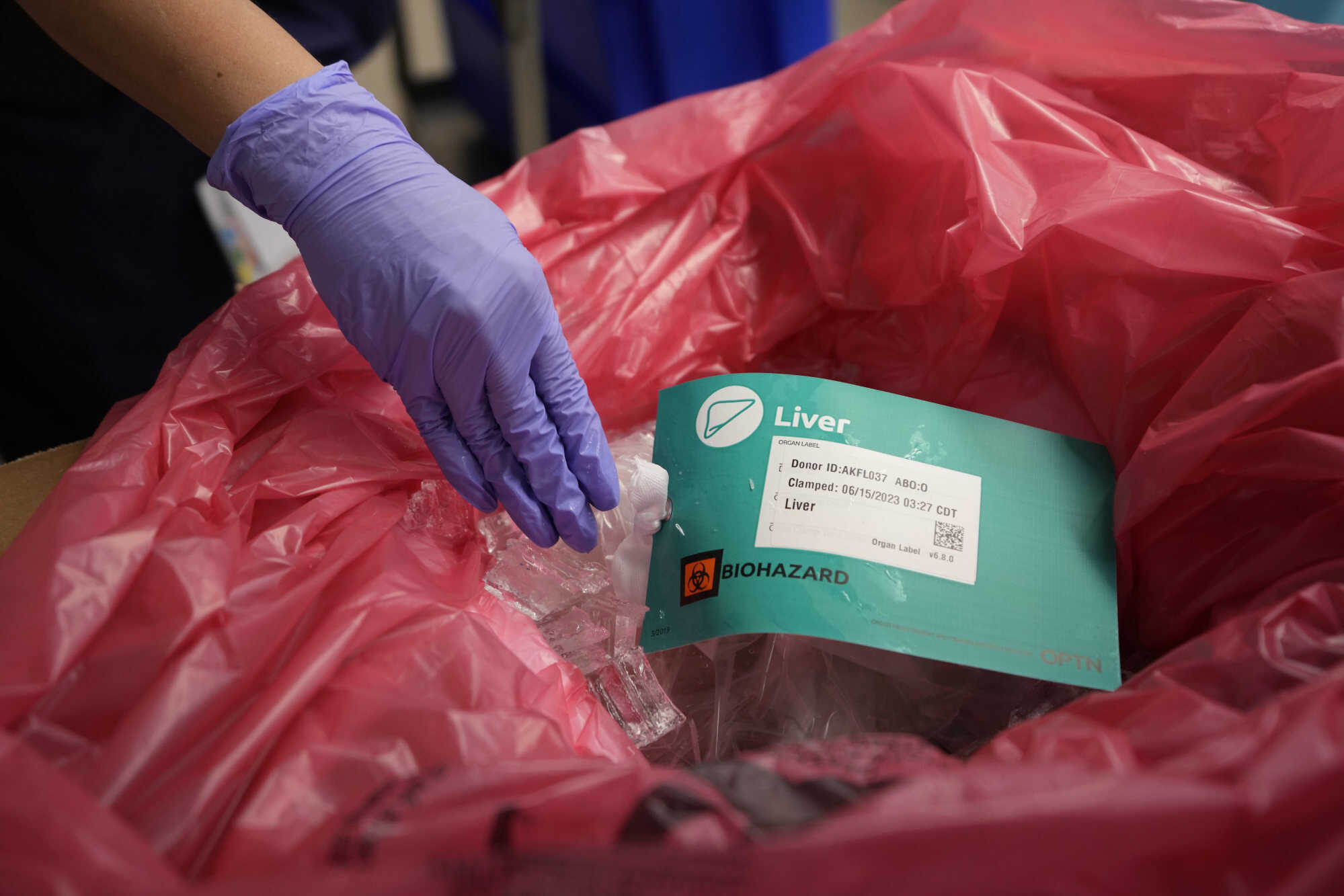 A liver is prepared for transport after it has been removed from an organ donor. Photo: AP