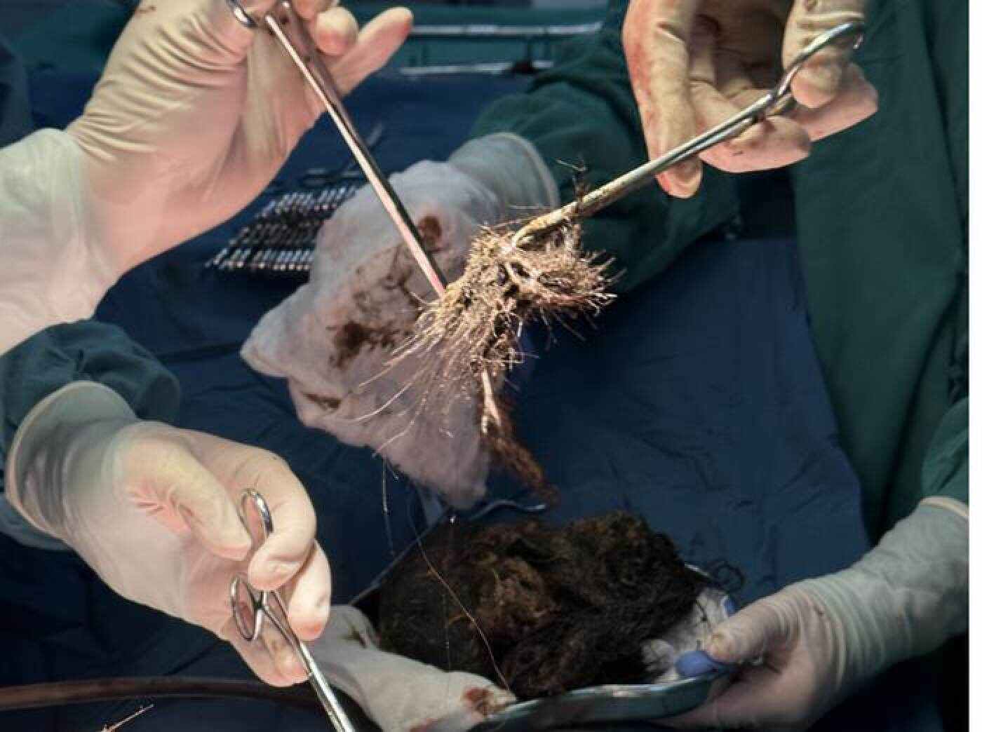 A prompt diagnosis is key for treating trichophagia, and it is important to seek medical advice early. Photo: Douyin