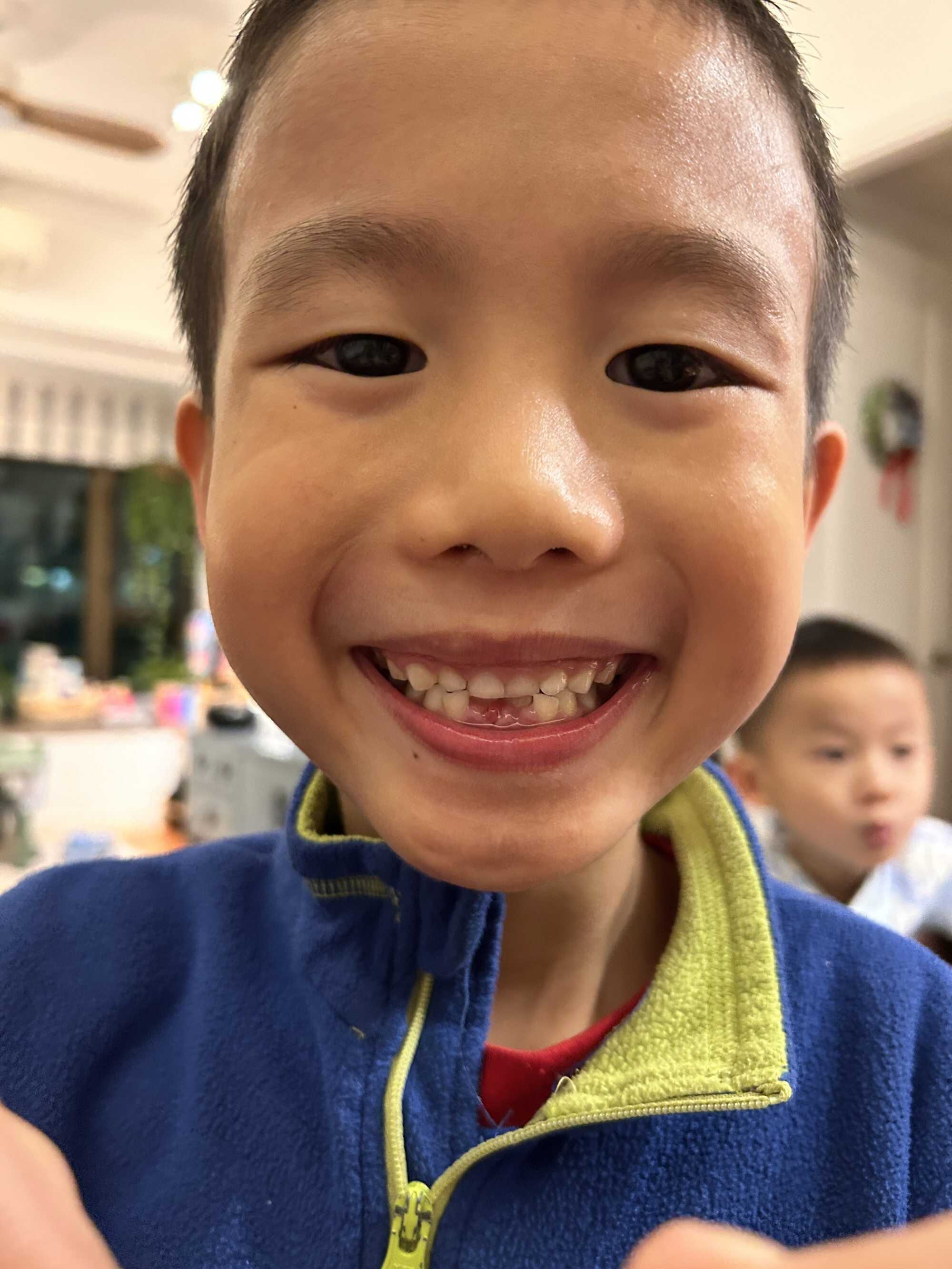 Lukas Wang shows off his missing teeth. Photo: Handout