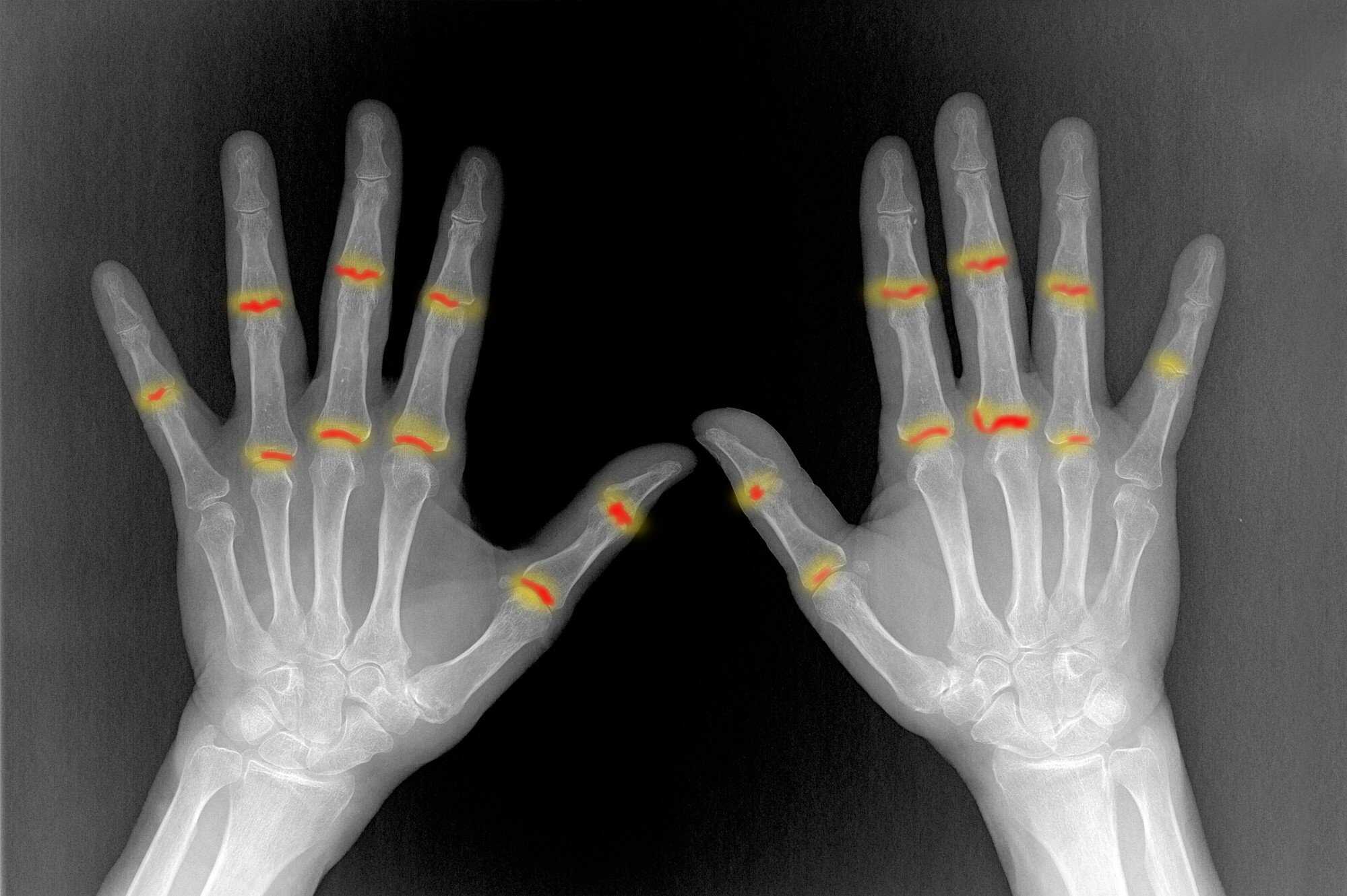 Finger and wrist pain can develop into serious joint issues, even in a child. Photo: Shutterstock